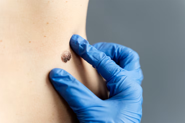 Wart Removal