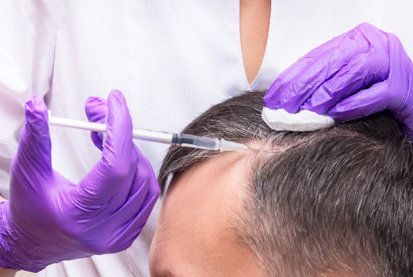 PRP for Hair
